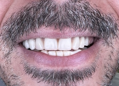 İMPLANT TEDAVİSİ İLE TEK  SEANSTA SABİT DİŞLER (İMMEDİAT YÜKLEME)